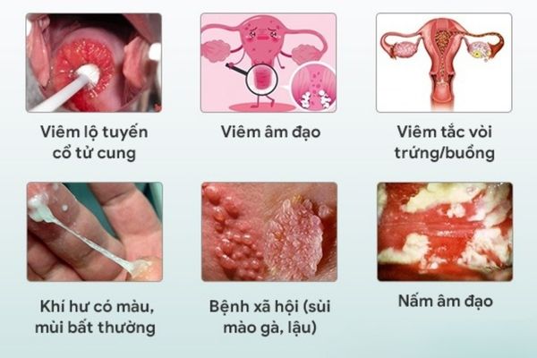 Khám phụ khoa giúp phòng tránh các bệnh lý phụ khoa phát sinh