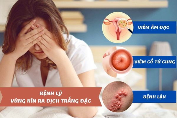 Vùng kín ra dịch trắng đặc là cảnh báo nhiều bệnh lý phụ khoa 