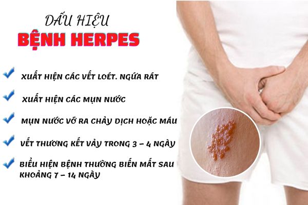 Dấu hiệu nhận biết bệnh Herpes nên lưu ý