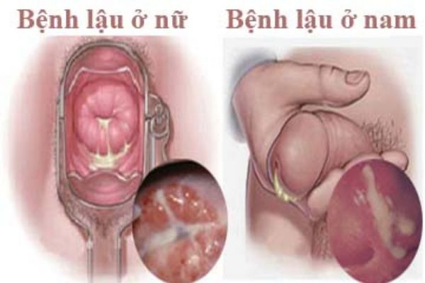 Dấu hiệu nhận biết bệnh lậu ở nam và nữ giới