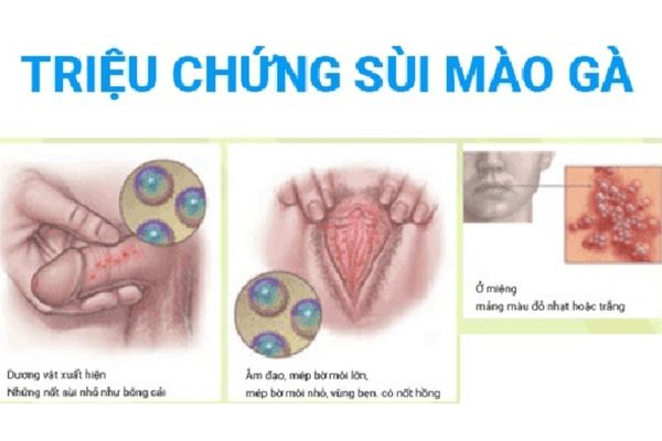 Bệnh sùi mào gà có thể gặp ở cả nam và nữ