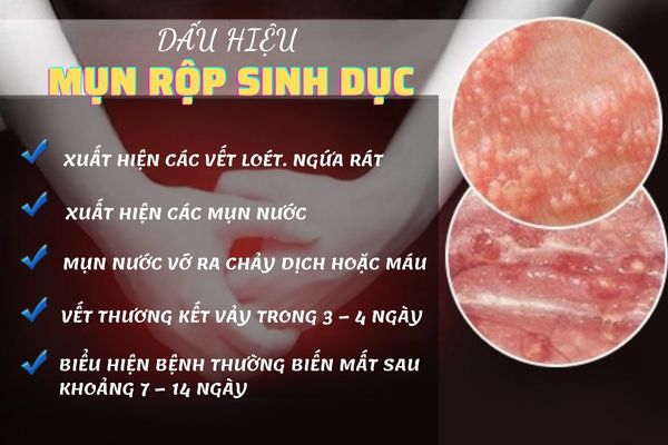 Dấu hiệu nhận biết mụn rộp sinh dục