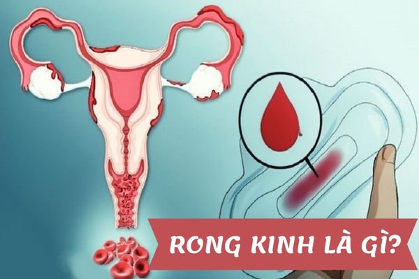 Rong kinh là gì? Bị rong kinh phải làm sao?