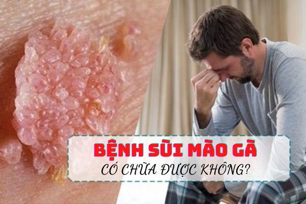 [Giải đáp thắc mắc] Bệnh sùi mào gà có chữa được không?