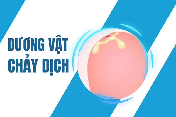 Dương vật chảy dịch cảnh báo bệnh lý gì? Cách điều trị hiệu quả