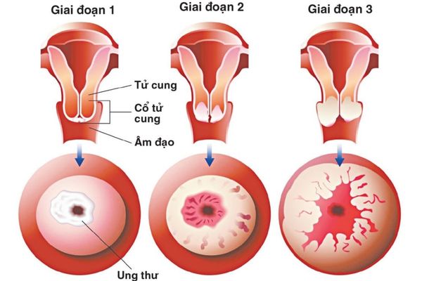 Dấu hiệu nhận biết bệnh lậu mãn tính – Hướng điều trị hiệu quả