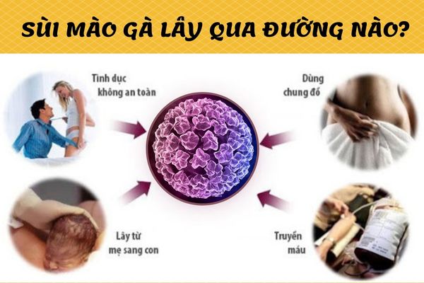 Sùi mào gà có khả năng lây nhiễm cao qua nhiều con đường khác nhau