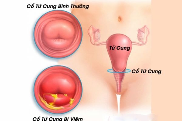 Những loại thuốc chữa viêm bao quy đầu an toàn và hiệu quả