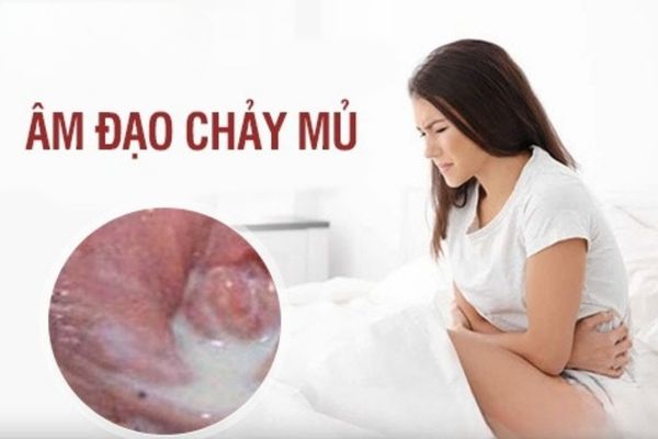 Âm đạo chảy mủ là biểu hiện của bệnh gì? Có nguy hiểm không?