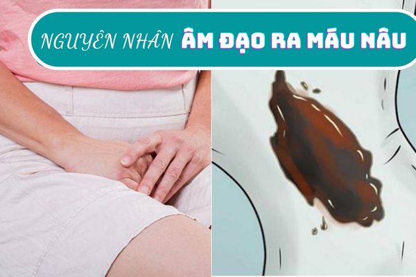 Âm đạo ra máu nâu – Dấu hiệu nhận biết bệnh phụ khoa nguy hiểm