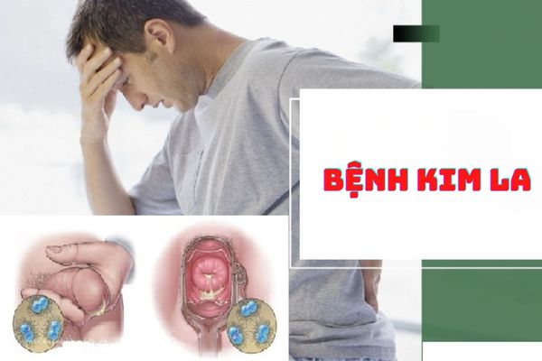 Bệnh kim la là bệnh gì – Nguyên nhân, triệu chứng và cách chữa trị