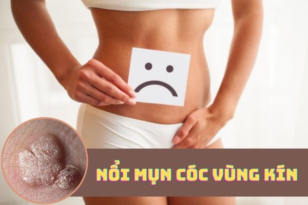 Nổi mụn cóc vùng kín – Triệu chứng bệnh lý không nên xem thường