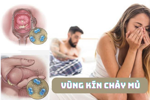 Vùng kín chảy mủ – Cảnh báo bệnh lý không nên xem thường