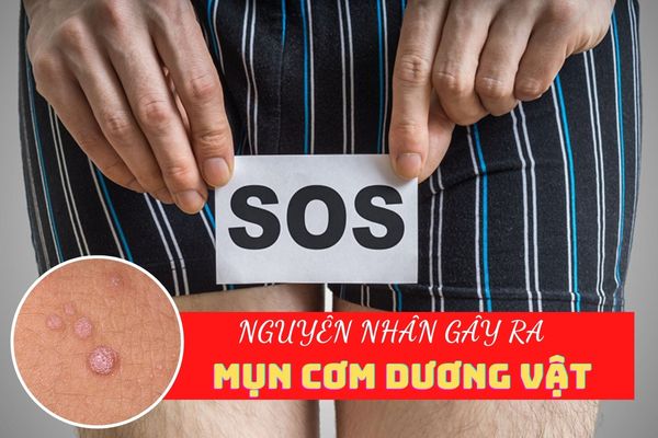 Lý giải nguyên nhân gây ra tình trạng mụn cơm dương vật