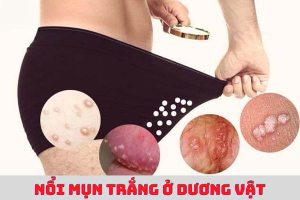 Bệnh mụn rộp nam là gì và điều trị ra sao?