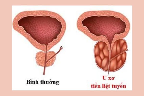 Benh-nam Gioi-thuong-gap (7)