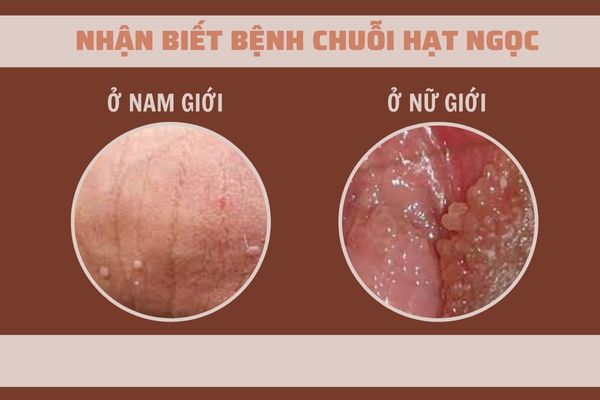 Chuoi-hat-ngoc-o-nam-nu-gioi-va-cah-dieu-tri (2)