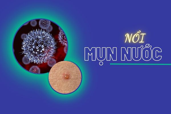 Nổi mụn nước cảnh báo bệnh xã hội nguy hiểm