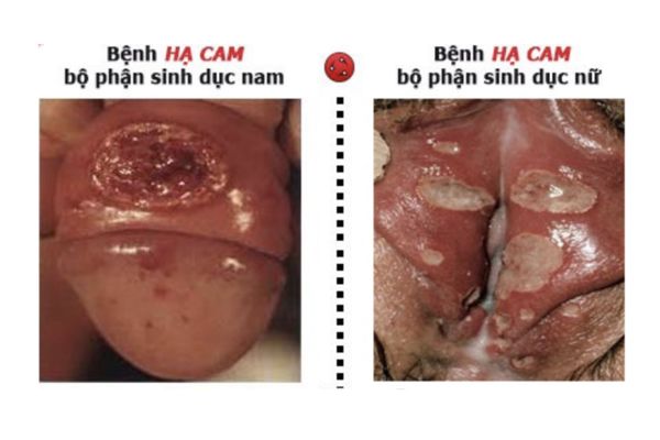 Tong-hop-su-that-can-biet-ve-benh-ha-cam-mem-1