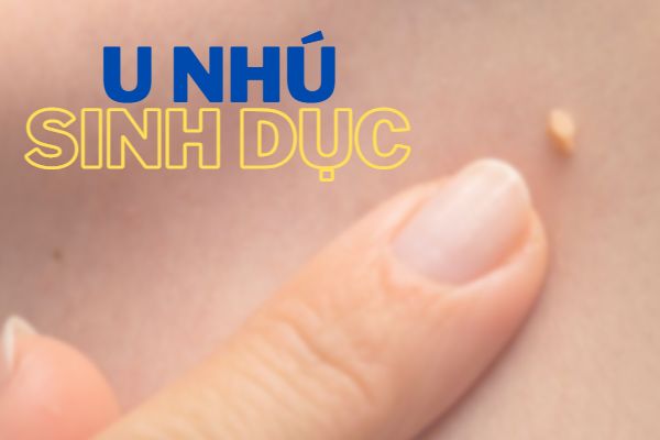 U nhú sinh dục là gì? Có điều trị được không?