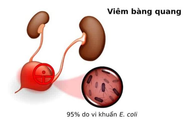 Viem-bang-quang (2)