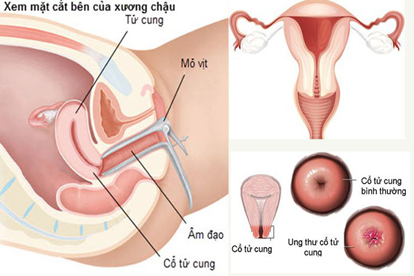 Tam-quan-trong-sinh-thiet-co-tu-cung