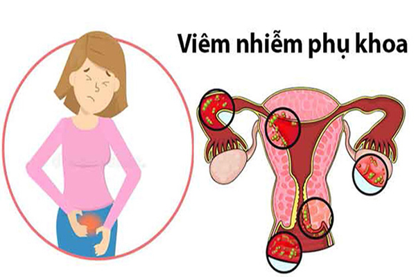 Viêm Nhiễm Phụ Khoa Là Gì? Triệu Chứng, Chẩn đoán