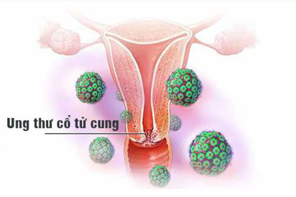 Virus Hpv-gay-ung-thu-co-tu-cung