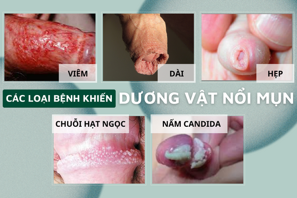 Can-trong-khi-duong-vat-noi-mun-1