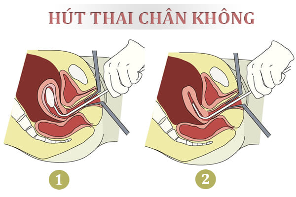 Các phương pháp phá thai theo tháng tuổi an toàn và những điều cần biết 