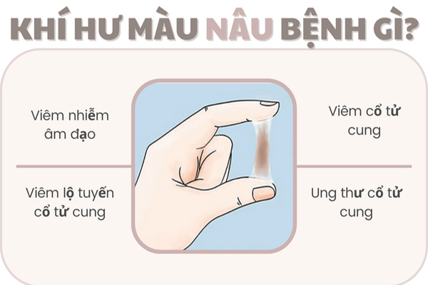 Khí hư màu nâu là bệnh gì và chữa như thế nào?