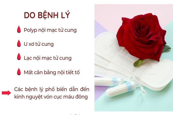 Kinh nguyệt vón cục bất thường dấu hiệu cảnh báo bệnh lý phụ khoa