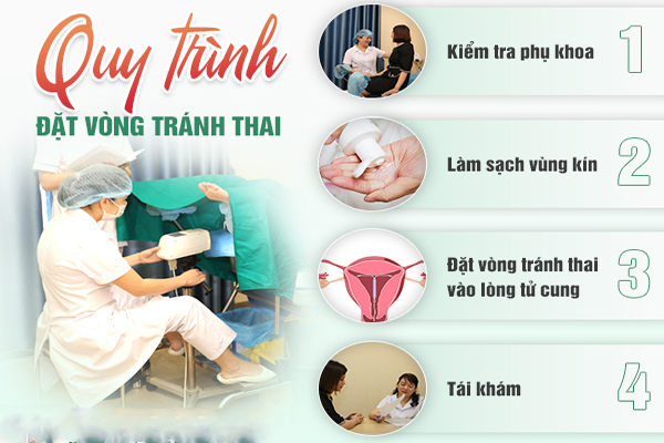 Quy trình đặt vòng tránh thai an toàn