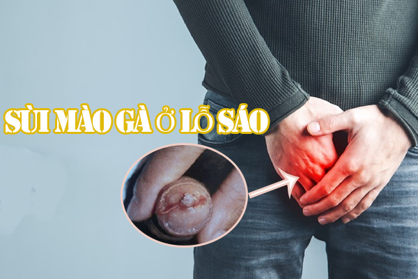 Sùi mào gà ở lỗ sáo: Dấu hiệu, tác hại và cách điều trị