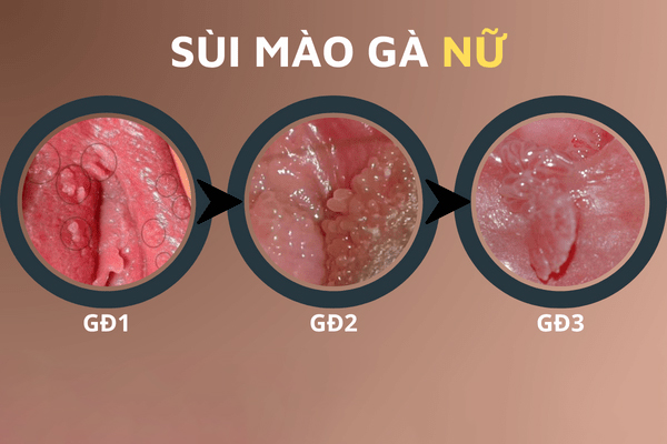 Triệu chứng sùi mào gà ở nữ dễ nhận ra