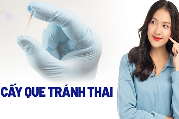 Cấy que biện pháp phòng tránh thai cho hiệu quả tối ưu nhất