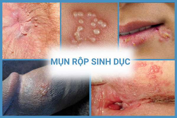 Mun-rop-sinh-duc