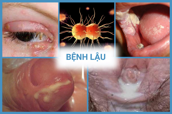 Benh-lau-5