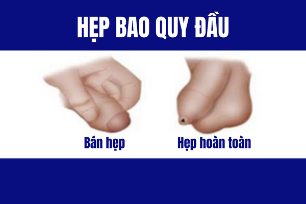 Hep-bao-quy-dau-hoi-chung-nguy-hiem-pho-bien-o-nam-gioi-1