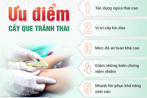 Cấy que tránh thai cho hiệu quả ngừa thai cao và lâu dài