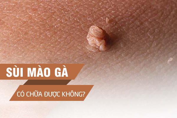 Bệnh Sùi Mào Gà Có Chữa Được Không?