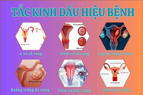 Tắc kinh dấu hiệu cảnh báo nhiều bệnh lý