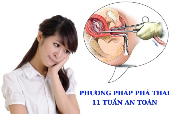 Thực hiện phá thai 11 tuần bằng biện pháp nào?