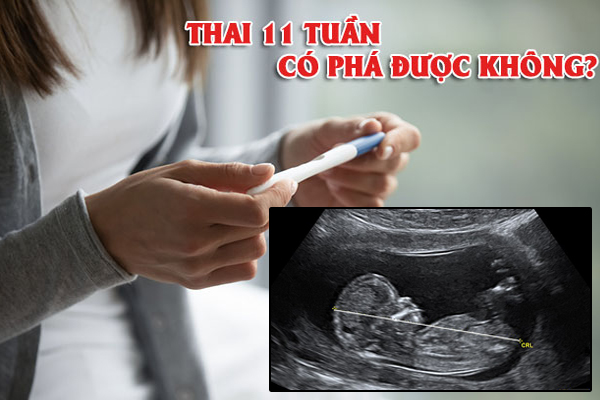 Tìm hiểu phương pháp và chi phí phá thai 11 tuần tuổi