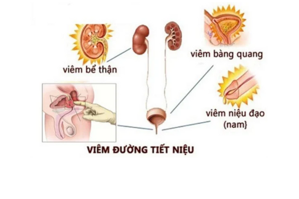 Dia-chi-chua-viem-duong-tiet-nieu-nam-uy-tin-1