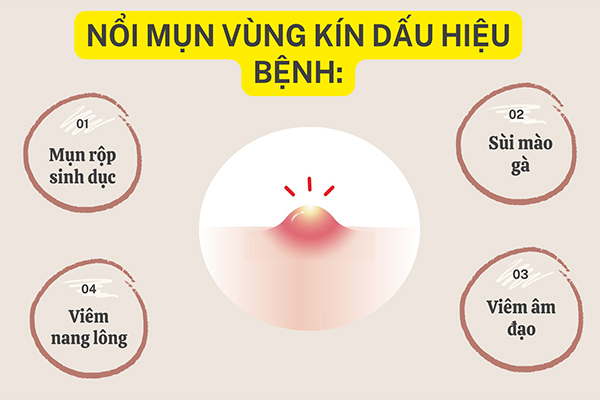 Nổi mụn vùng kín – Chị em chớ chủ quan