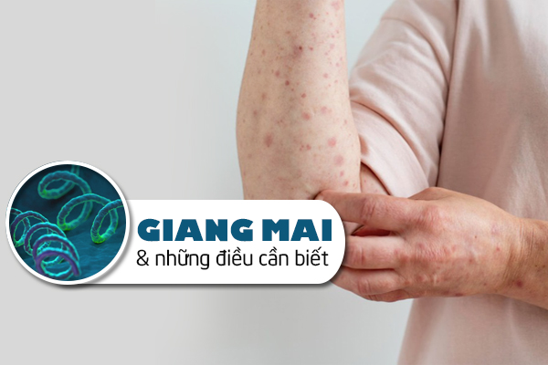 Bệnh giang mai và những thông tin cần biết