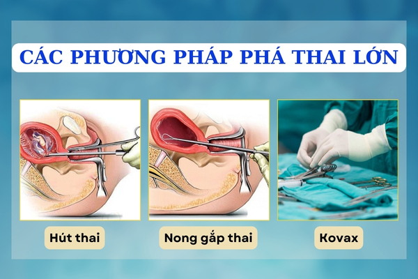 Thai lớn phá được không? Phương pháp thực hiện như thế nào?