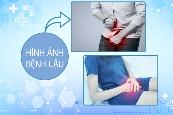 Xem ngay hình ảnh bệnh lậu ở nam và nữ giới